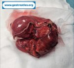 intestinal-occlusion-due-to-pelvic-endometriosis