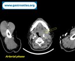 tonsil-lymphoma
