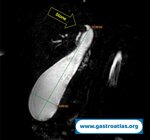 cystic-duct-stone-mrcp-and-eus