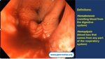hematemesis-or-hemoptysis