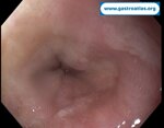 esophageal-stricture-in-endometrial-cancer