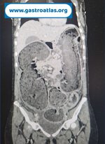 intestinal-occlusion-due-to-pelvic-endometriosis