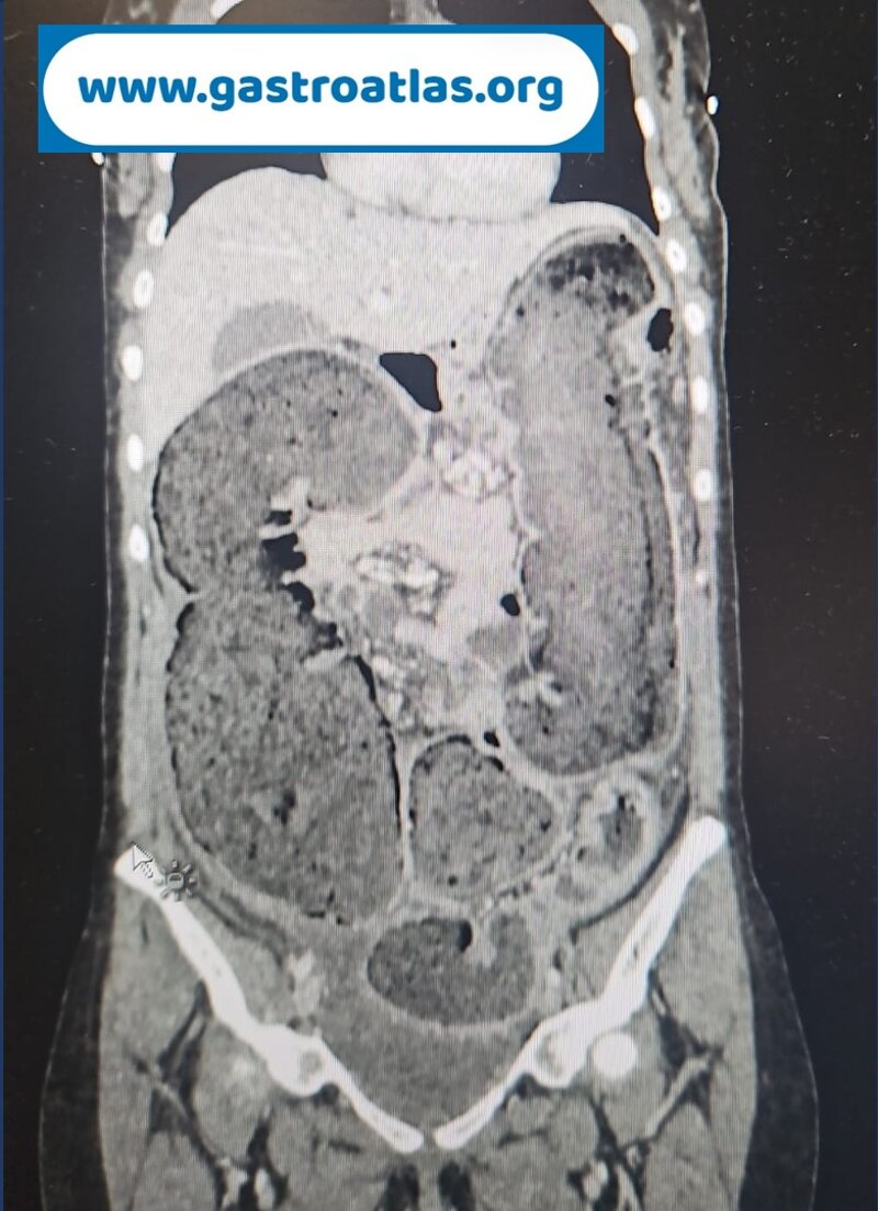 intestinal-occlusion-due-to-pelvic-endometriosis