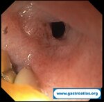 esophageal-stenosis-secondary-to-amyloidosis-part-1