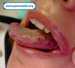 blue-rubber-bleb-nevus-syndrome-brbns