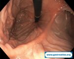 biliopancreatic-diversion-bpd-endoscopic-images