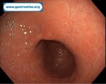 collagenous-gastritis