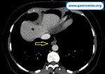real-time-view-of-ultrasound-eus