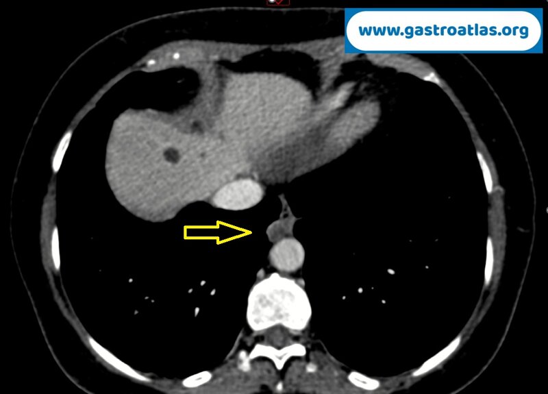 real-time-view-of-ultrasound-eus-not-a-leiomyoma-but-a-pleural-lesion