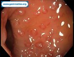antibiotic-associated-colitis-caa-and-clostridium-difficile-infection-cdi