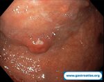 gastric-net-in-atrophic-gastritis