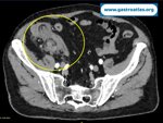 appendicitis