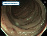 colonic-inverted-diverticulum-icd