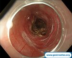 advancing-esophageal-motility-treatment-with-poem-and-endoflip