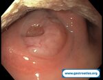tonsil-lymphoma