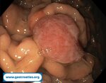 gastric-metastasis-from-renal-cell-carcinoma
