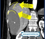 percutaneous-liver-biopsy-hematoma