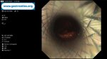 esophageal-stricture-in-endometrial-cancer