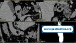 duodenal-duplication-cyst