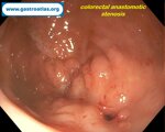 colorectal-anastomotic-stenosis