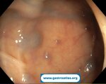 blue-rubber-bleb-nevus-syndrome-brbns