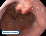 esophageal-adenocarcinoma-in-gastric-banding