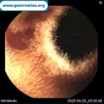 videocapsule-endoscopy-vce-in-glanzmanns-thrombasthenia