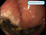 duodenal-bulb-perforation-peptic-ulcer
