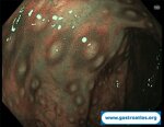 antibiotic-associated-colitis-caa-and-clostridium-difficile-infection-cdi