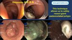 endoloop-polypectomy-tips-and-tricks