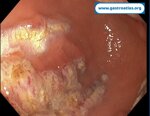 argon-plasma-coagulation-apc-treatment-of-gastric-antral-vascular-ectasia-gave