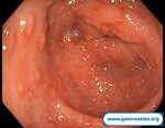 antibiotic-associated-colitis-caa-and-clostridium-difficile-infection-cdi