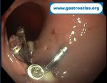 post-polypectomy-bleeding-coagrasper-use