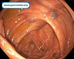 blue-rubber-bleb-nevus-syndrome-brbns
