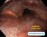 laryngeal-serous-cysts-can-miming-symptoms-of-reflux-disease-gerd