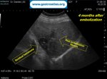 percutaneous-liver-biopsy-hematoma