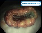 post-polypectomy-bleeding-coagrasper-use