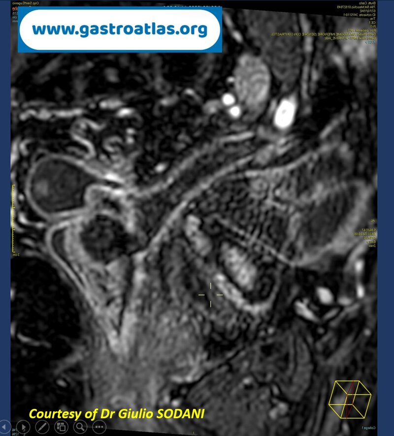 pre-anastomotic-fistula-in-colorectal-anastomosis-part-2-mri-view