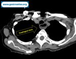 esophageal-stricture-in-endometrial-cancer