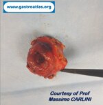 duodenal-gist