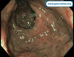 antibiotic-associated-colitis-caa-and-clostridium-difficile-infection-cdi