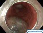 advancing-esophageal-motility-treatment-with-poem-and-endoflip