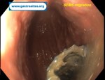 esophageal-stricture-secondary-to-amyloidosis-part-3-sems-removal