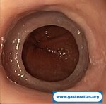eosinophilic-esophagitis-mucosal-friability-and-esophageal-rings