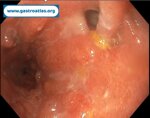 pre-anastomotic-fistula-in-colorectal-anastomosis-part-1-endoscopic-view