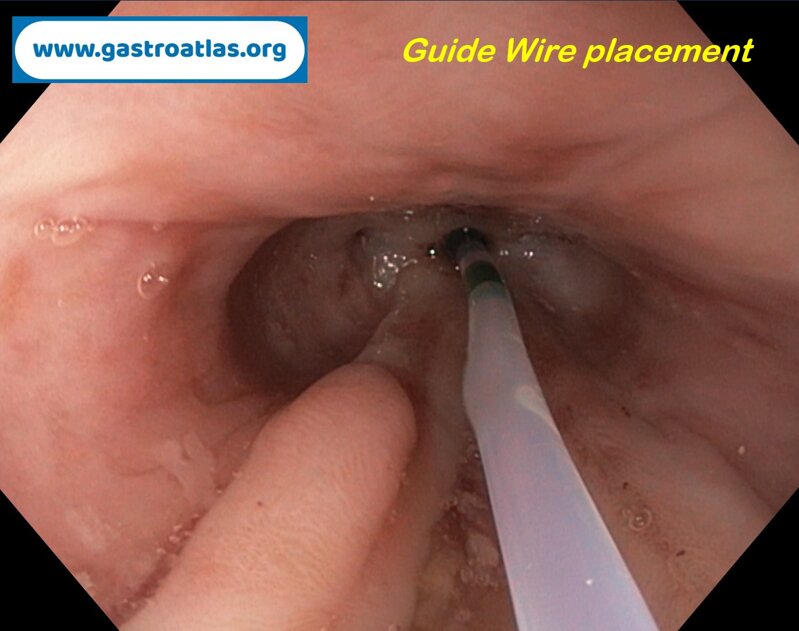 esophageal-stricture-secondary-to-amyloidosis-part-2-sems-placement