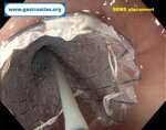 esophageal-stricture-secondary-to-amyloidosis-part-2
