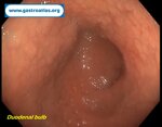 small-bowel-adenocarcinoma-sba-resulting-from-undiagnosed-celiac-disease