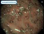 antibiotic-associated-colitis-caa-and-clostridium-difficile-infection-cdi