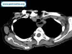 esophageal-stricture-in-endometrial-cancer